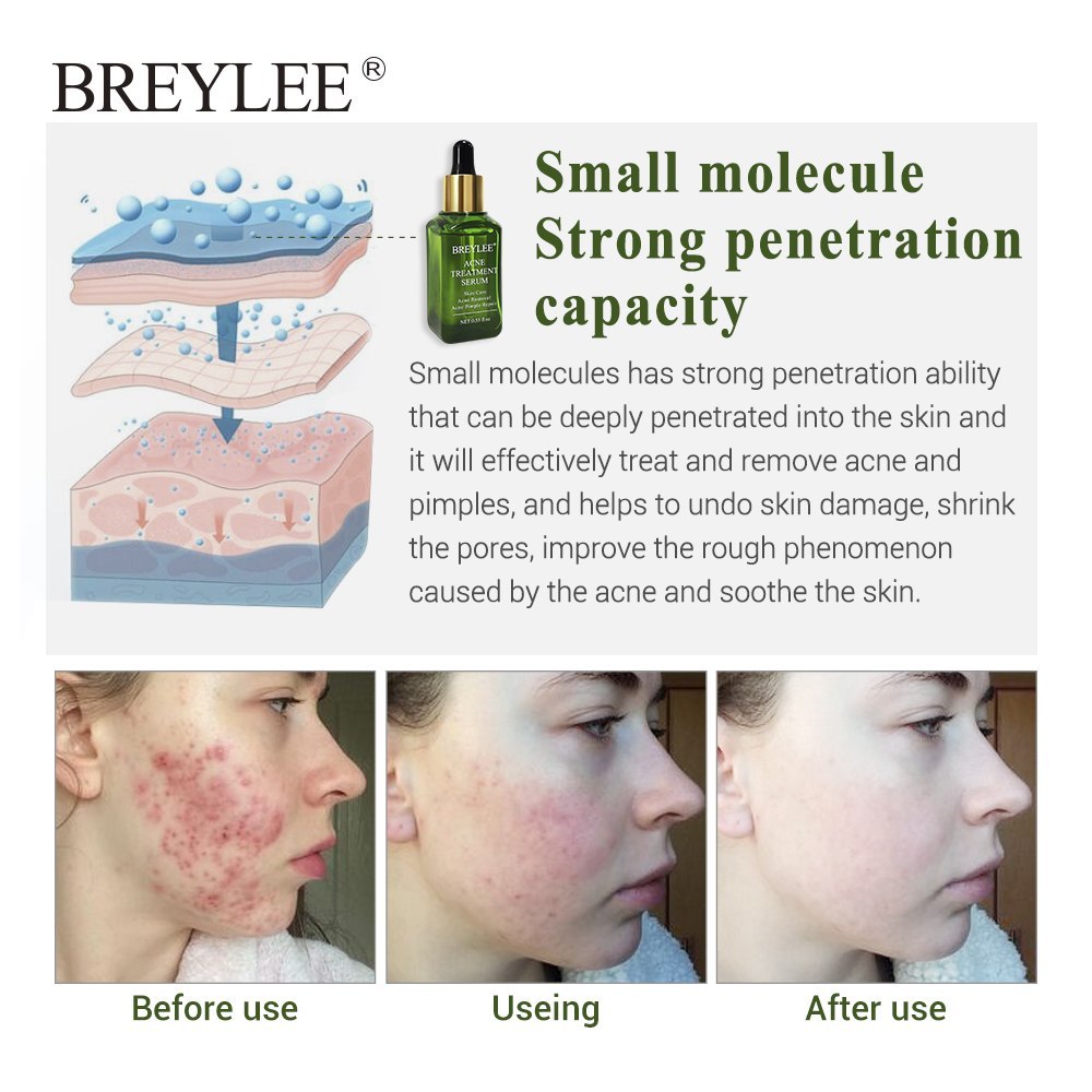 BREYLEE Acne Treatment Serum Face Facial Anti Acne Scar Removal Cream Skin Care Whitening Repair Pimple Remover For Acne BREYLEE Acne Treatment Serum Face Facial Anti Acne Scar Removal Cream Skin Care Whitening Repair Pimple Remover For Acne